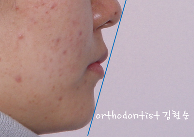 강남 돌출 관련 이미지 26