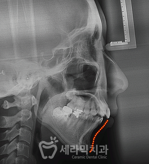 앞니 돌출, 개방교합으로 치아교정을 시작했는데, 작았던 아래턱이 커졌어요! 관련 이미지 17