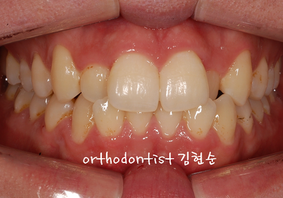 반대교합 관련 이미지 3