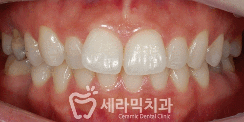 나비치아, 앞니돌출, 과개교합 치아교정전후 관련 이미지 6