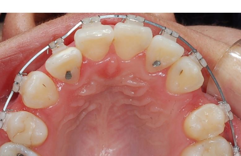세라믹치과 수술없이 돌줄입교정 관련 이미지 6