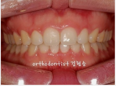 강남 과개 교합 관련 이미지 9