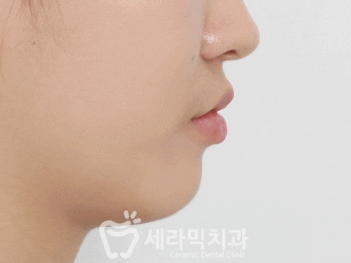 치열불규칙과 돌출입 치아교정전후 턱라인 변화! 관련 이미지 2