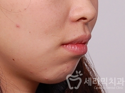 무턱교정, 거미스마일 교정 잘하는 학동역 세라믹치과 관련 이미지 4