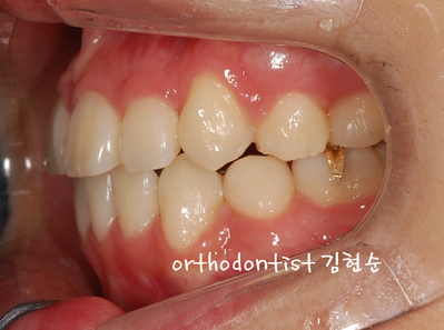 강남 덧니 관련 이미지 28
