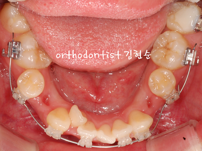 치열 교정(치열 불규칙) 관련 이미지 22