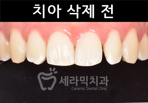 무삭제라미네이트 , 세라네이트가 궁금하다면? 관련 이미지 3