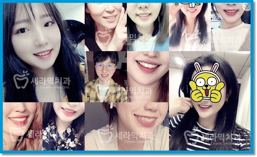 치열불규칙 치아교정으로 활짝 웃게 된 치아교정전후 관련 이미지 5