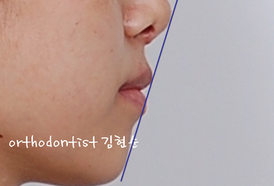 강남 덧니, 돌출 관련 이미지 11