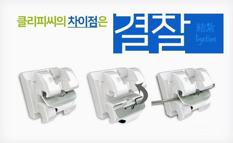 학동역치과 클리피씨 교정이란 ? 관련 이미지 3