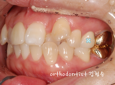 강남 덧니, 돌출 관련 이미지 17