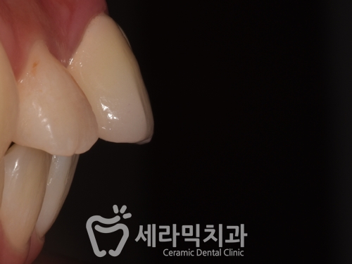 돌출입 치아벌어짐 치아재교정 전후. 세라믹치과 관련 이미지 3