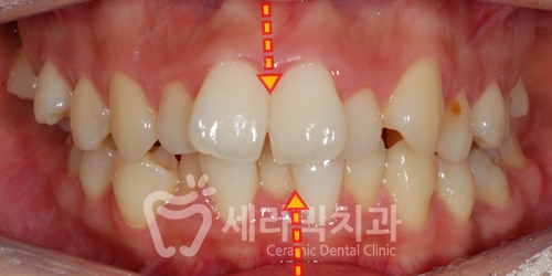 치아교정만으로 세마리 토끼를 한번에! 돌출입, 무턱, 치열불규칙 치아교정전후 관련 이미지 3