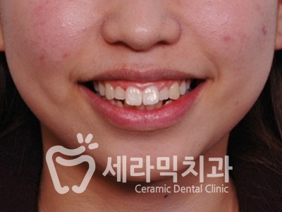돌출입 잇몸노출 치아교정 전후 인상변화 사례 관련 이미지 2