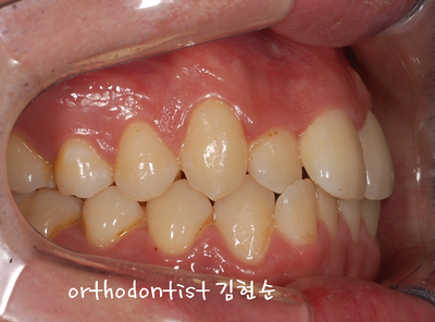 반대교합 관련 이미지 7