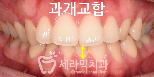 과개교합과 돌출입 개선으로 달라진 인상, 세라믹치과 치아교정전후! 관련 이미지 1