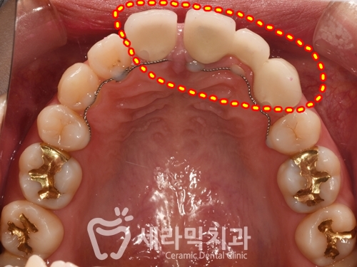 돌출입 치아벌어짐 치아재교정 전후. 세라믹치과 관련 이미지 5