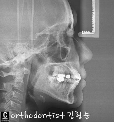 강남 덧니, 돌출 관련 이미지 34