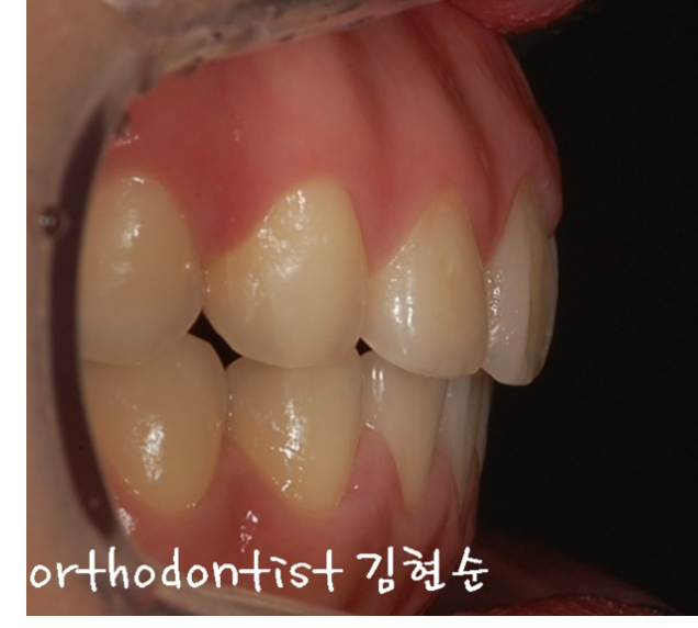 학동역치과 돌출입교정은 세라믹치과에서 관련 이미지 9