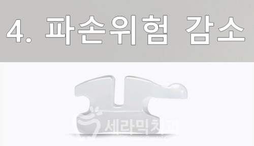 세라믹교정, 세라믹치과에서 하면 좋은 이유! 관련 이미지 7