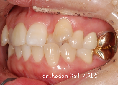 강남 덧니, 돌출 관련 이미지 9