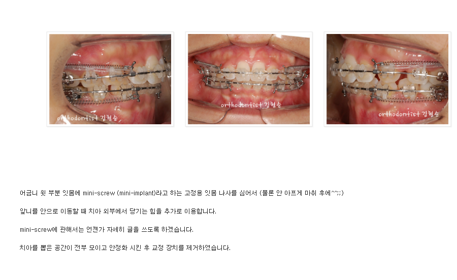 세라믹교정 세라믹치과-돌출입발치교정 7 관련 이미지 5