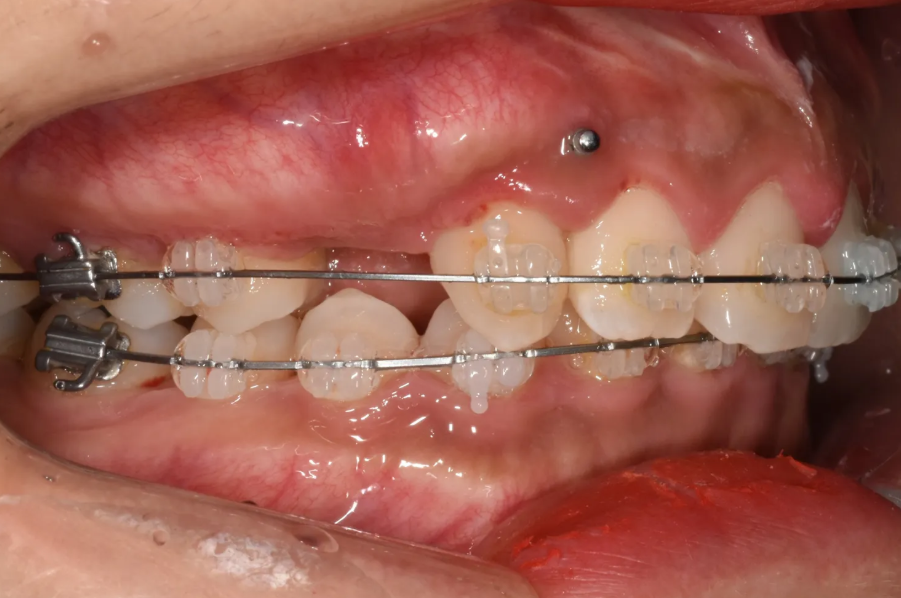 과개교합 교정: 비수술로 치료한 토끼 이빨 이야기 관련 이미지 8