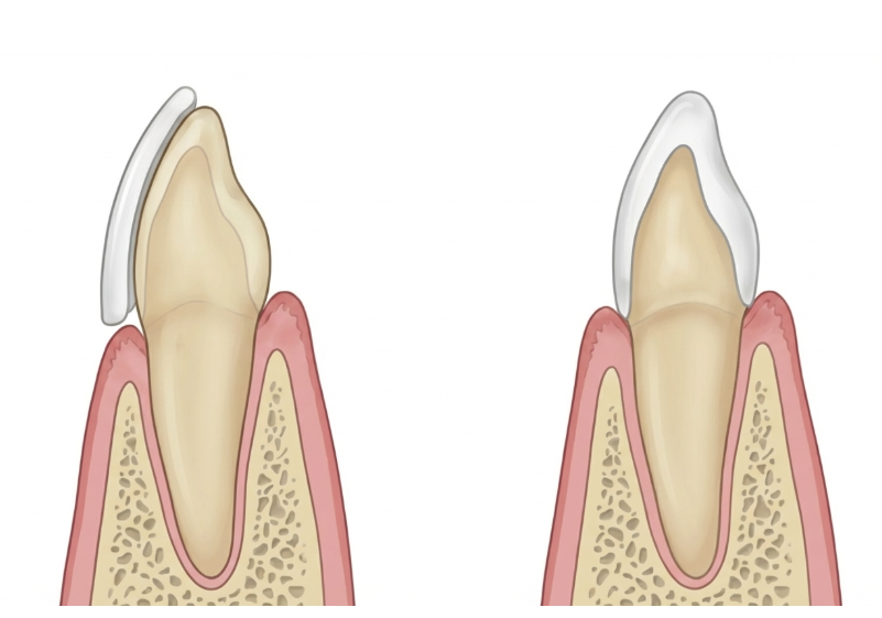 치아부식과 심미성을 동시에 잡은 앞니 치료 (ft. 역류성 식도염) 관련 이미지 9