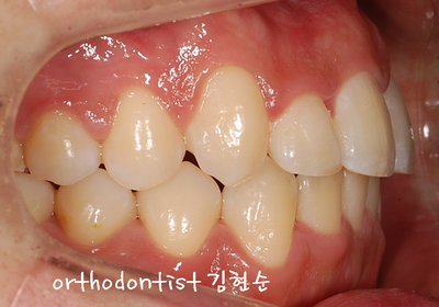 반대교합 관련 이미지 22