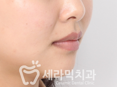토끼이빨, 틀어진 치아배열 세라믹교정 전후사진 관련 이미지 17