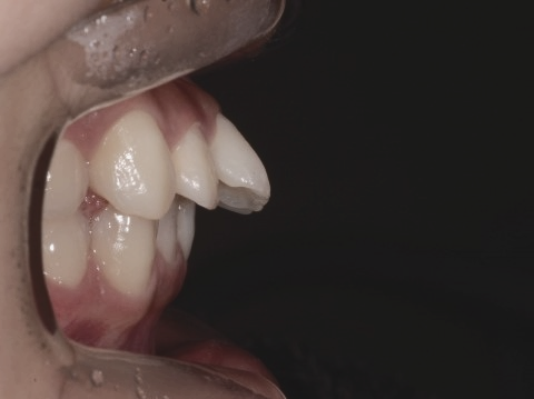 학동역치과 하면 세라믹교정 ~ 관련 이미지 15