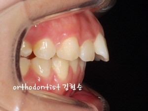 학동역치과 돌출입교정 세라믹치과에서 ~ 관련 이미지 2