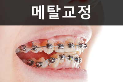 세라믹교정 잘하는 곳은? 세라믹치과 관련 이미지 7