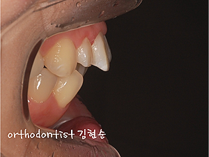 강남 돌출입 교정 관련 이미지 15