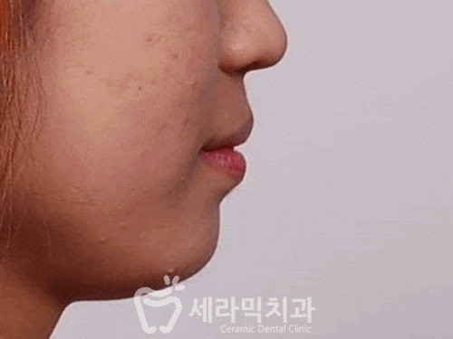 치아교정전후, 돌출입치아교정으로 변화한 얼굴! 관련 이미지 2
