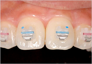 세라믹교정 세라믹치과 클리피씨교정 이야기 관련 이미지 5