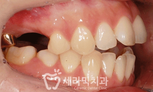 상실된 치아가 있어도, 금니가 있어도 치아교정전후는 계속된다! 관련 이미지 6