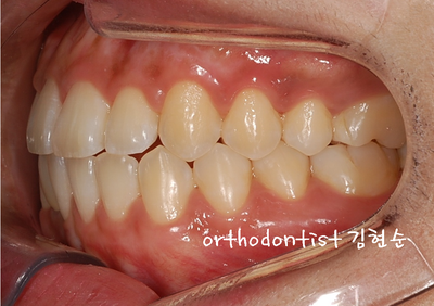 치열 교정 ( 벌어짐 ) 관련 이미지 22