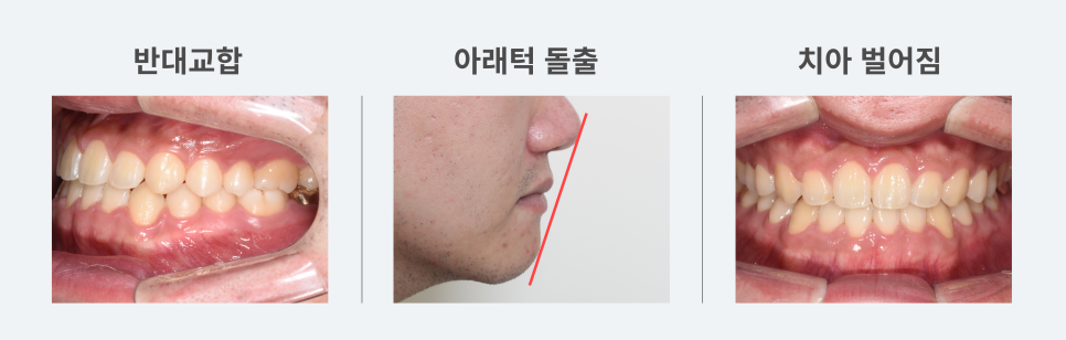 치아가 반대로 물리는 관련 이미지 5