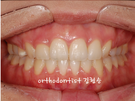 강남 돌출입 교정 관련 이미지 31