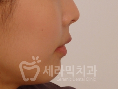 돌출입 덧니 비대칭 치아교정 전후 인상변화! 관련 이미지 20