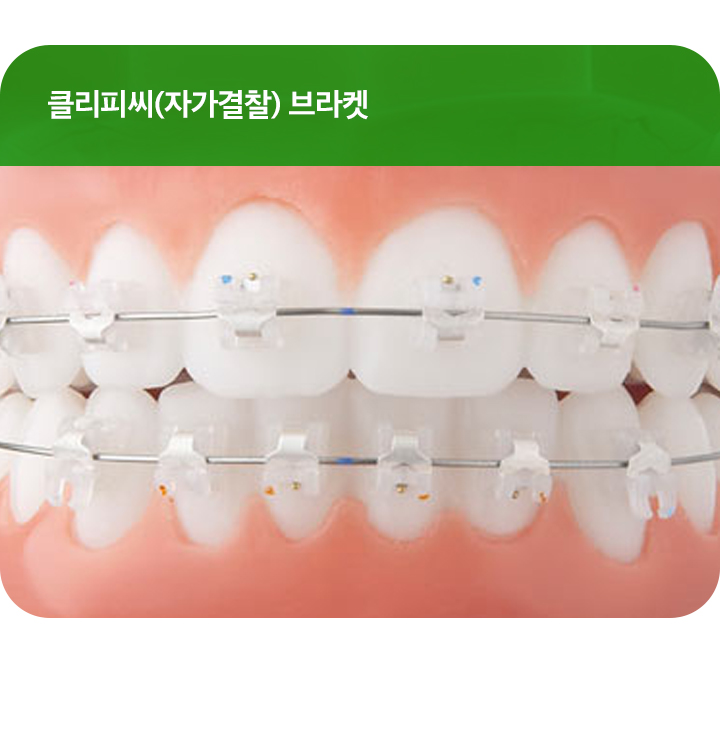 강남치아교정 브라켓비교분석 관련 이미지 4