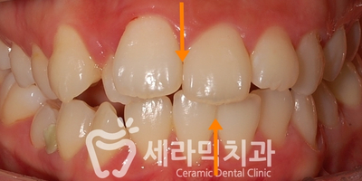 치아교정 전후 스마일라인 변화!(돌출입,토끼앞니, 중심선 비대칭 동시 교정) 관련 이미지 5