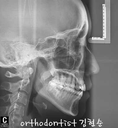 개방 교합 관련 이미지 14