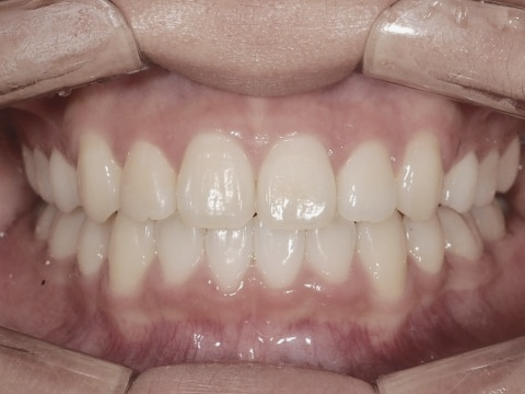 학동역치과 하면 세라믹교정 ~ 관련 이미지 21