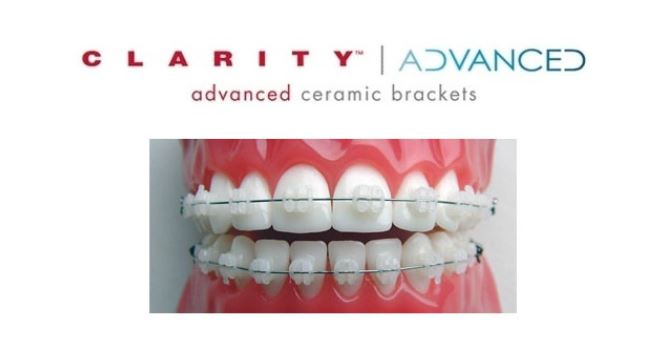 세라믹교정 장점 관련 이미지 4