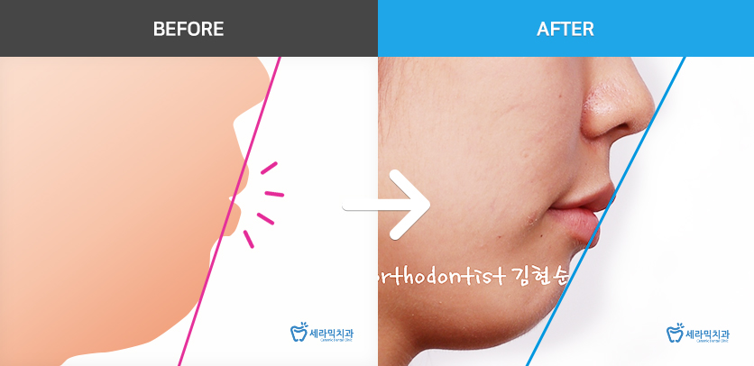 학동역치과 미국3M교정 추천 ~~ 관련 이미지 13