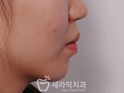 치아교정전후 : 돌출입과 치열불규칙을 발치교정으로 개선! 관련 이미지 2