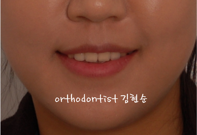 치열 교정(치열 불규칙) 관련 이미지 30