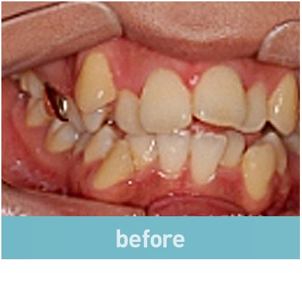 비발치교정 무조건 좋은 것만은 아니다? 관련 이미지 2